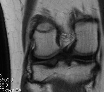 LCL Chronic Distal Avulsion MRI